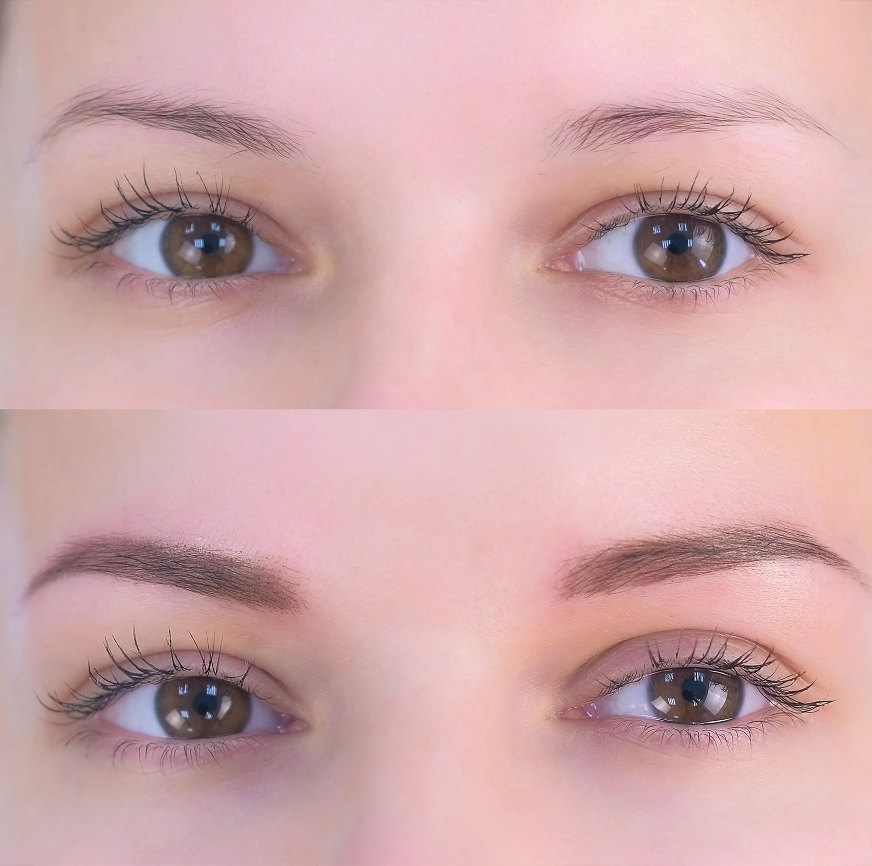 blépharoplastie