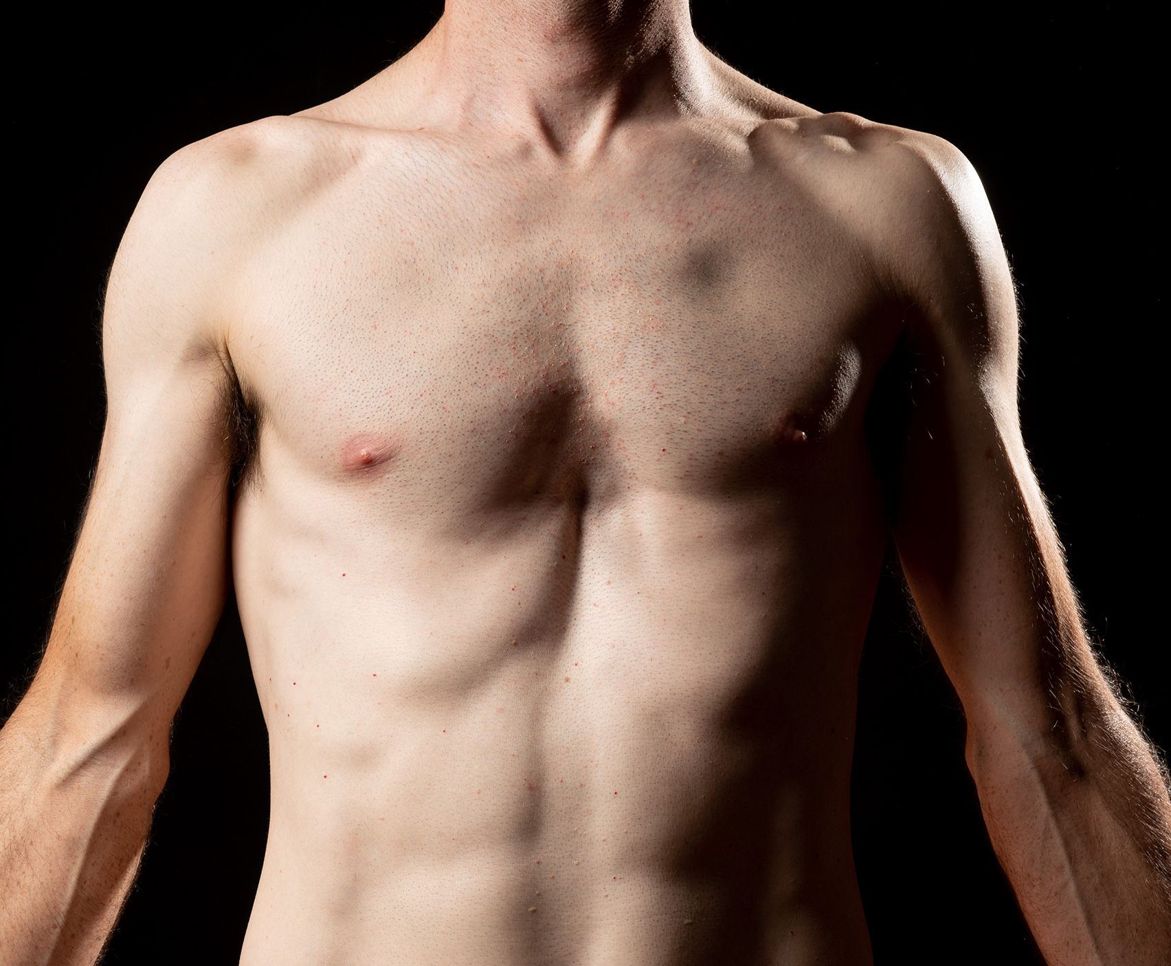 resultat gynecomastie